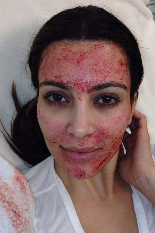 Kim Kardashian opted for the Vampire facelift to maintain youthful look; Kim soon after the procedure