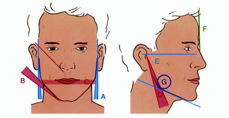 CHISELLED Treatment