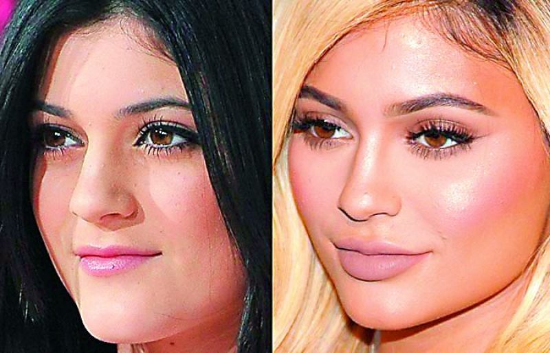 Kylie Jenner (before and after)
