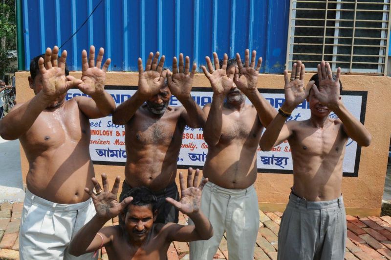 Villagers show their hands after drinking arsenic contaminated groundwater