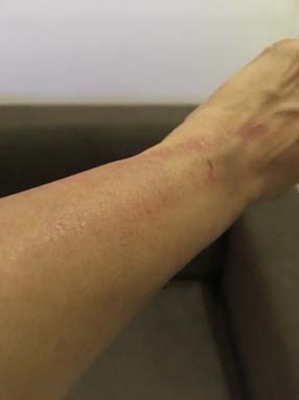 Photo of Suchi's bruised hand