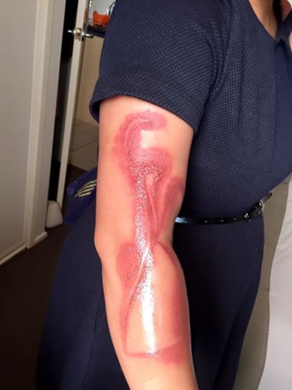 Apple's iPhone 7 has caused a pregnant woman in Australia second-degree burns on her right arm after falling asleep.