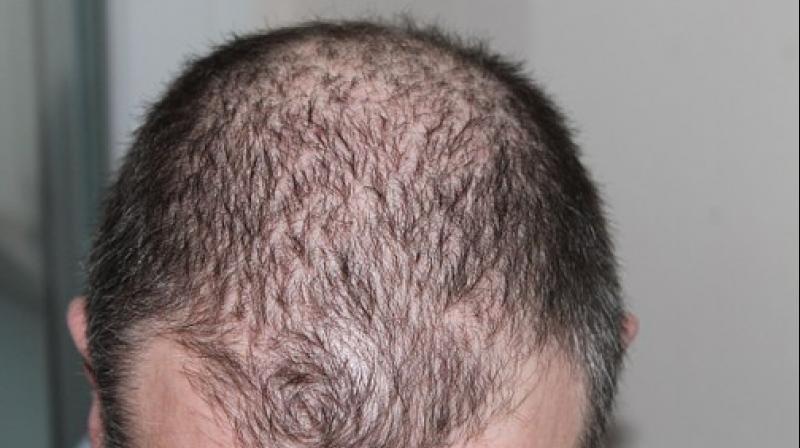 Breakthrough invention: Prevent hair loss due to chemotherapy