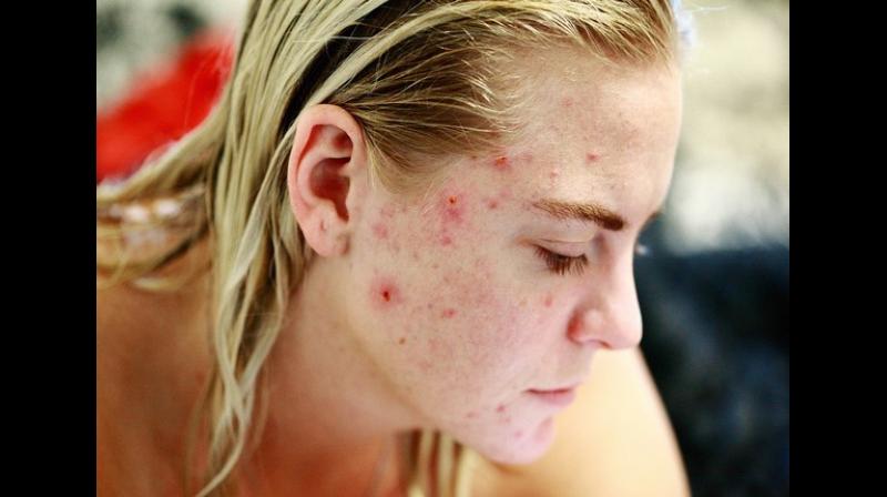 Those with acne at high risk of depression