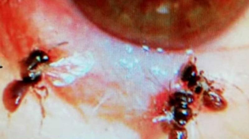 Shocking: 4 live bees found inside Taiwanese woman\s eye