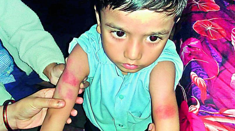 Parents of the boy show his bruised hands.(Image DC)