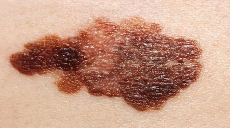 New way discovered to prevent melanoma