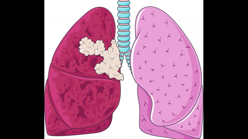 Hyderbad: 20per cent of cancer deaths are due to lung cancer