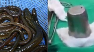Year ender 2017: The most bizarre things removed from inside people