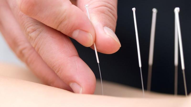 Researchers tested the traditional Chinese needle-piercing remedy in a trial involving nearly 150 babies (Photo: AFP)