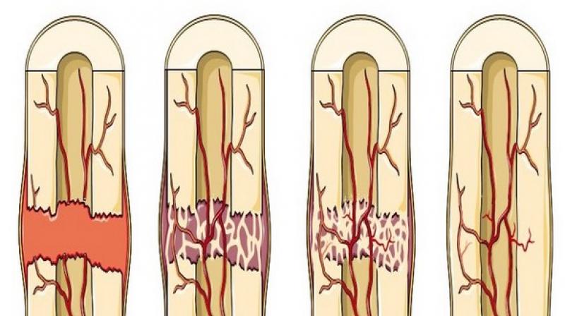 This protein consumption can slow down healing of fractures