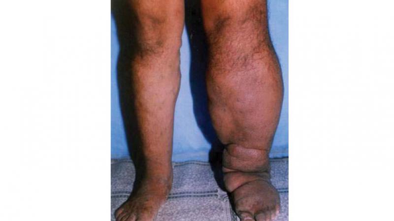 In January, two positive cases of filariasis have been reported in Kannur district, both migrant workers from Uttar Pradesh.