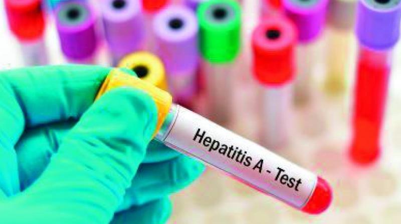 Hyderabad: Hepatitis A virus sees 300 per cent rise, says report