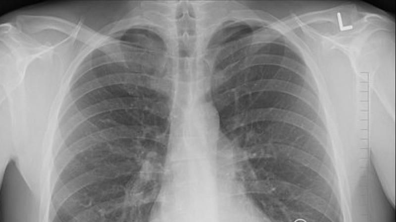 Tuberculosis majorly linked to lung damage