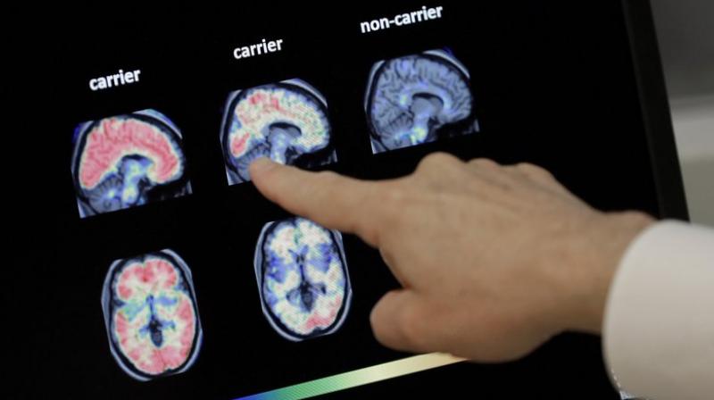 Drug company to seek approval for medicine to treat Alzheimerâ€™s