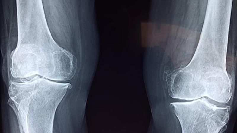 Five things you must consider before you opt for knee replacement