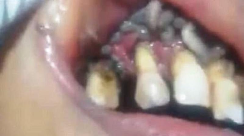 The clip shows bizarre consequences of poor oral hygiene (Photo: YouTube)