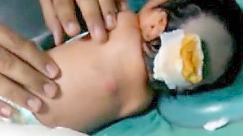 The injured newborn at Kamineni Hospital