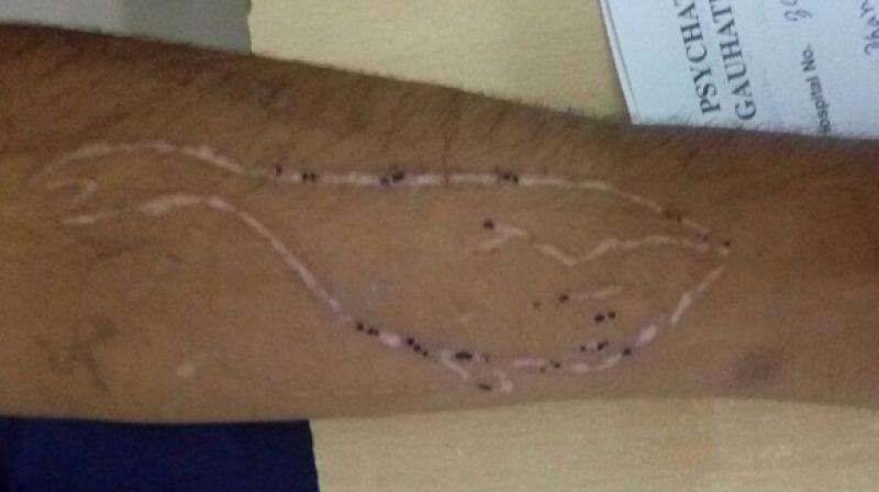 The student, with Blue Whale mark on his hand, was showing abnormal behaviour, after he played a few online games during the past few days. (Photo: ANI)