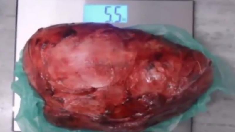 The mass removed measured 31 by 19 cm (Photo: YouTube)