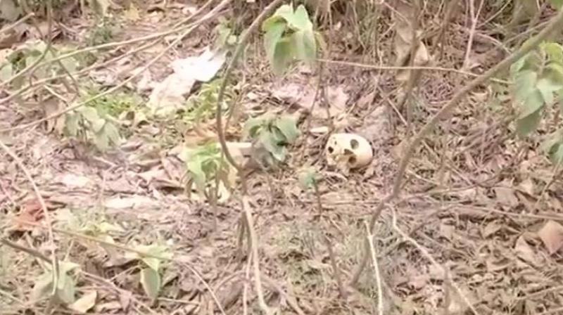 Muzaffarpur: Hundreds of human skeletons found abandoned near SKMCH hospital