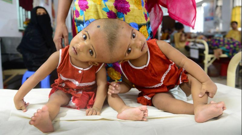 Prior to the surgery doctors had said there was only a 50 percent chance of both of the twins surviving. (Photo: AFP)