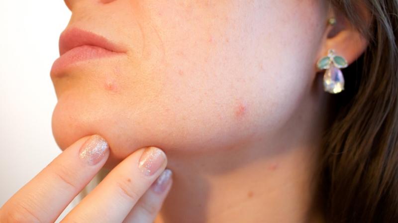 7 ways to get rid of adult acne. (Photo: Pixabay)