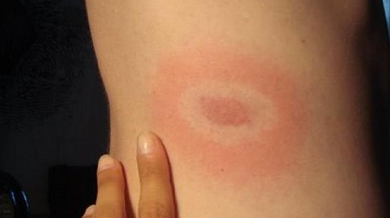 Now diagnose Lyme disease in just 15 minutes