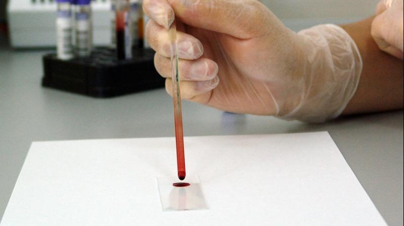 New blood test developed to detect alcohol misuse. (Photo: Pixabay)