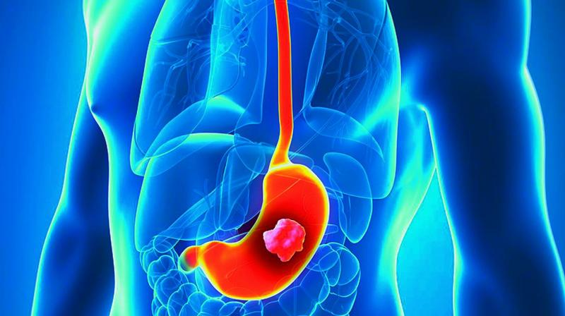 India remained witness to 57,000 new gastrointestinal cancer in 2018