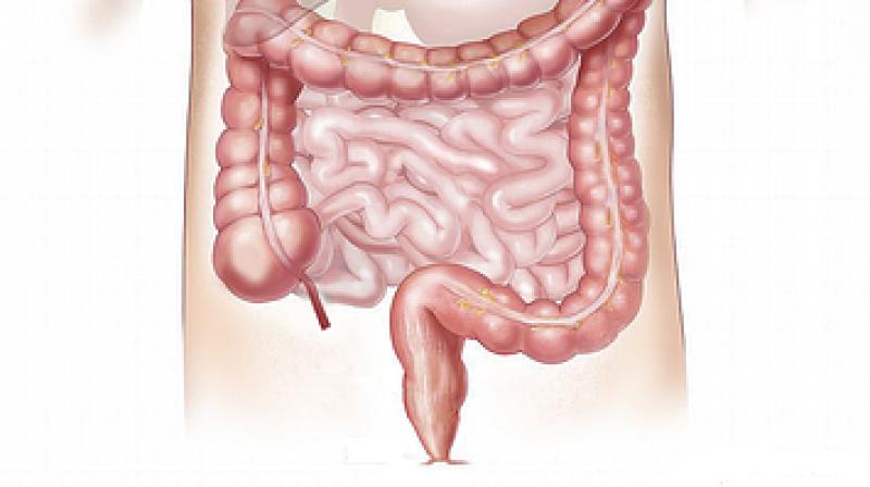 Diverticulitis is an inflammation of small pouches in the walls of the colon. (Photo: Pixabay)