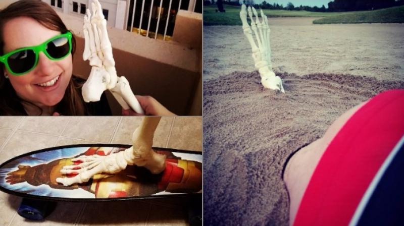 Cancer survivors amputated foot has its own Instagram account