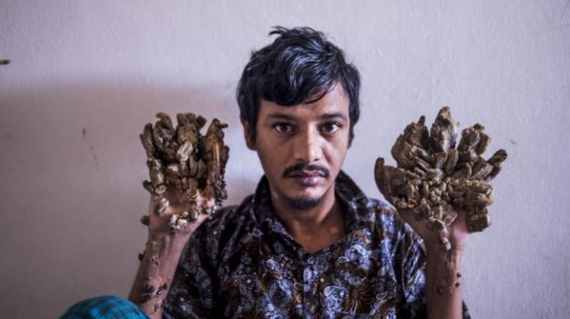 Bangladesh \Tree Man\ wants hands amputated to relieve pain