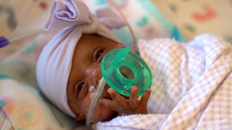 Miracle baby: Worldâ€™s tiniest surviving baby born in California