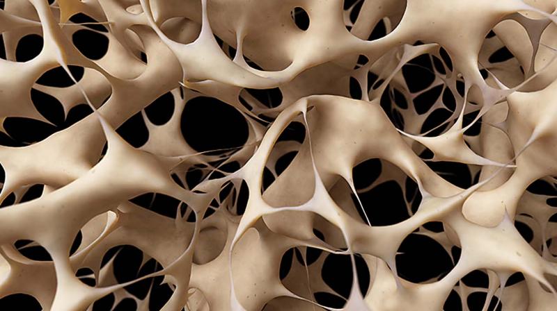 Osteoporosis means â€œporous boneâ€. Viewed under a microscope, healthy bone looks like a honeycomb.  (Source: Internet)