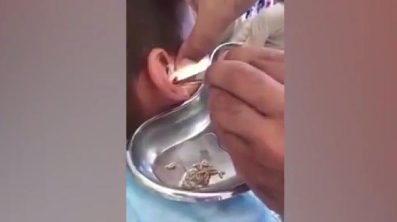 Footage shows doctors removing dozens of maggots which are then wriggling in the stainless steel container (Photo: Youtube)