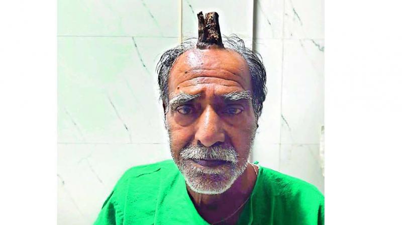 Plastic surgery rescues man with â€˜devilâ€™s hornâ€™ on head in MP