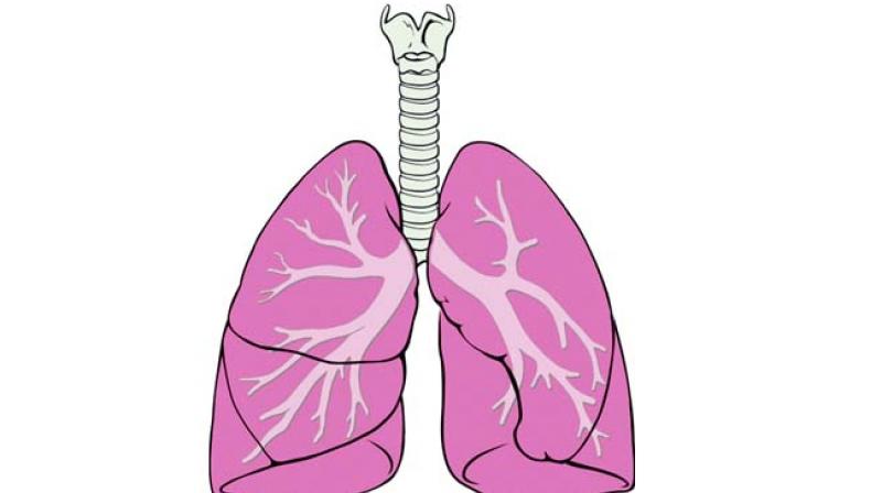 Interstitial lung disease or ILD is a broad category of lung diseases that includes more than 130 disorders characterised by fibrosis or inflammation of the lungs.
