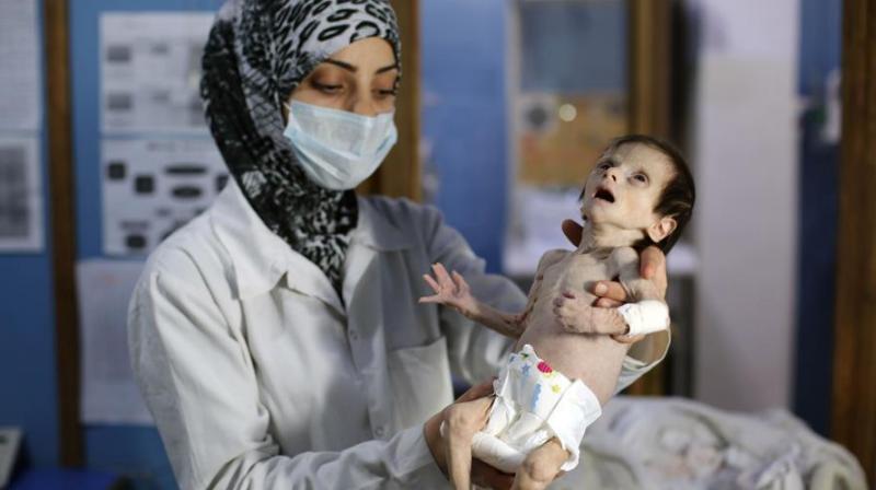 Like hundreds of children in Ghouta, Sahar was suffering from acute malnutrition (Photo: AFP)