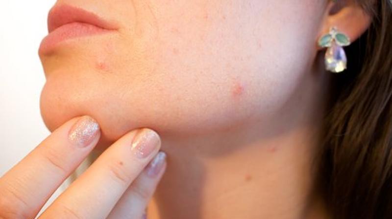 Micro-needling: New technique to improve appearance of acne scars