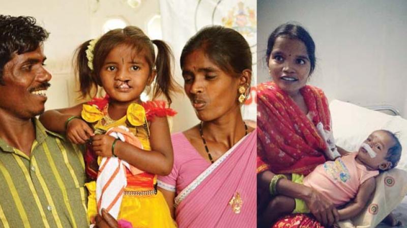 A gird child with cleft lip at the Trinity Care Foundation  (TCF). (Right )A baby after undergoing surgery