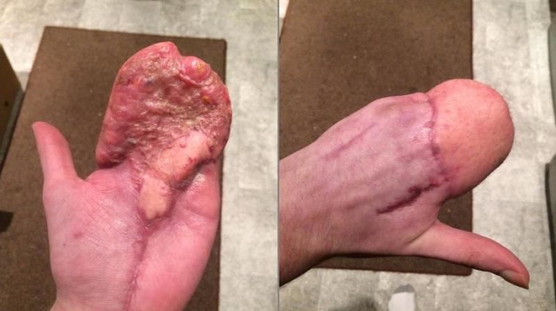 His fingers can be revived by transplants from toes (Photo: Facebook)
