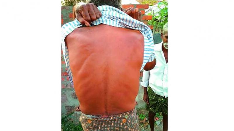 Gorla Saraiah shows the wounds on his back where he was beaten up by the forest beat officer on Sunday. 	 DC