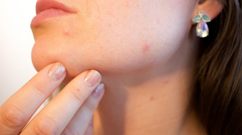 Excessive sweating during summers and exposure to the sun can aggravate the problem of acne, especially among people with sensitive skin. (Photo: Pixabay)