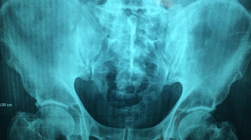 Total hip replacement is one of the most common elective operations. (Photo: Pixabay)