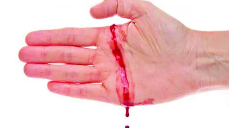 Hemophilia patients often bleed internally