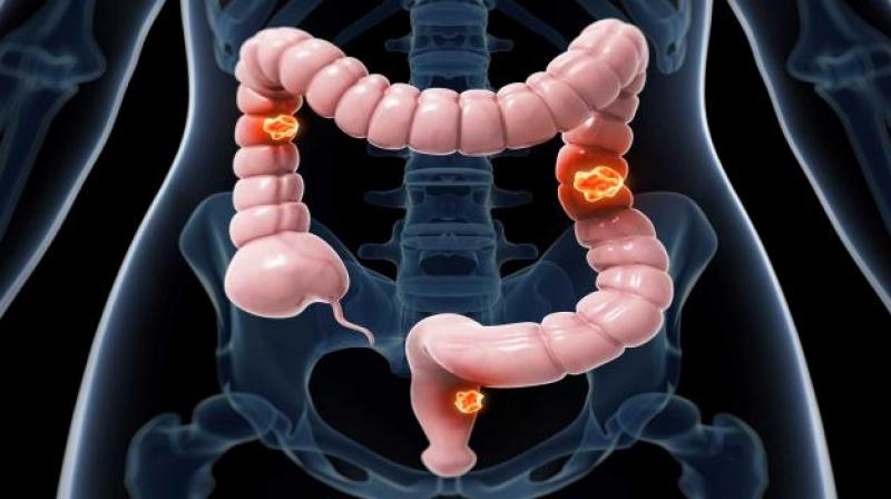 Colorectal cancer (CRC), one of the top three killers across the world, has  been witnessing around 1.4 lakh new cases and over six lakh deaths globally every year. (Image courtesy: http://yaletownnaturopathic.com)