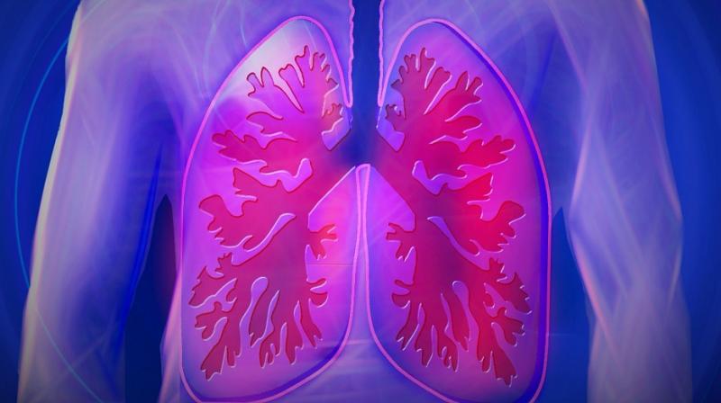 Small cell lung cancer, one of the most aggressive types of cancer. (Photo:Representational/Pixabay)