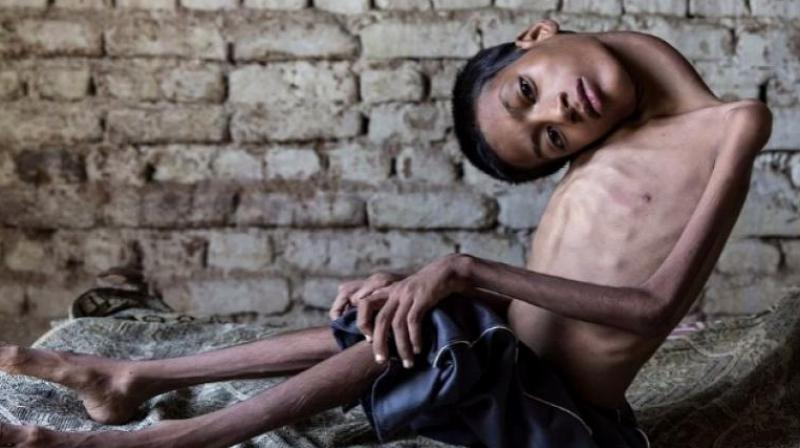 Mahendra Ahirwar was afflicted by a rare condition called congenital myopathy which made his neck muscles so weak that his head would hang to one side. (Credit: YouTube)