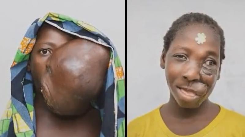 Apart from causing breathing issues, the tumour also restricted her from eating (Photo: YouTube)